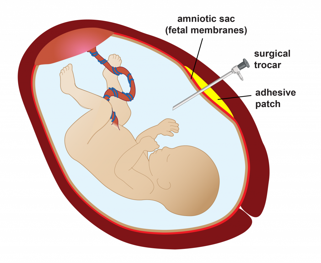 Fetal Surgery-Trocar and Patch8