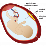 Fetal Surgery-Trocar and Patch8 small